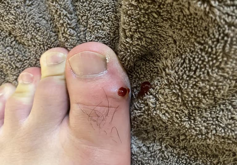 발가락에 난 물혹 - 결절종 짜보기-14