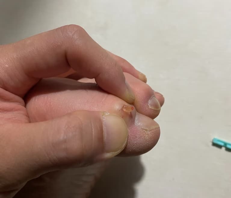 발가락에 난 물혹 - 결절종 짜보기-5