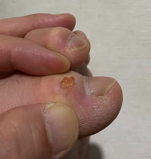 발가락에 난 물혹 - 결절종 짜보기-9