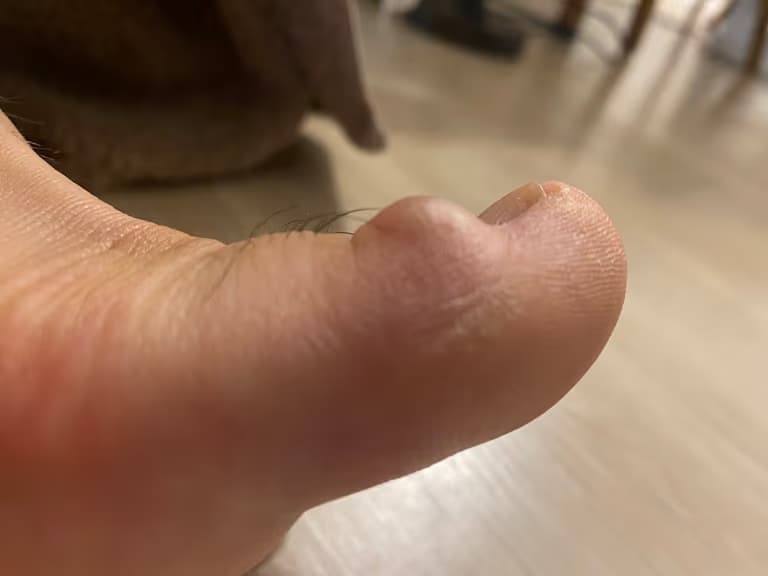 발가락에 난 물혹 - 결절종 짜보기-11