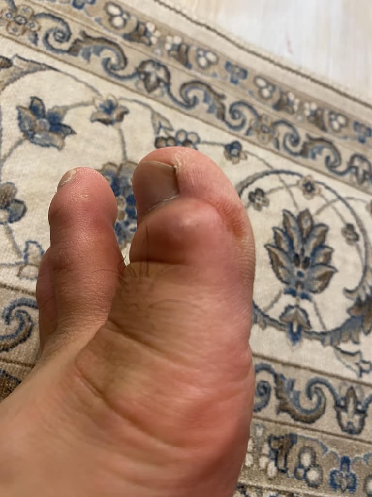 발가락에 난 물혹 - 결절종 짜보기-15