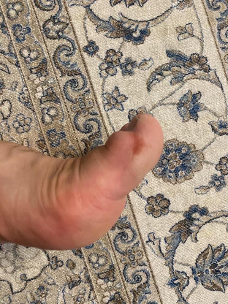 발가락에 난 물혹 - 결절종 짜보기-16