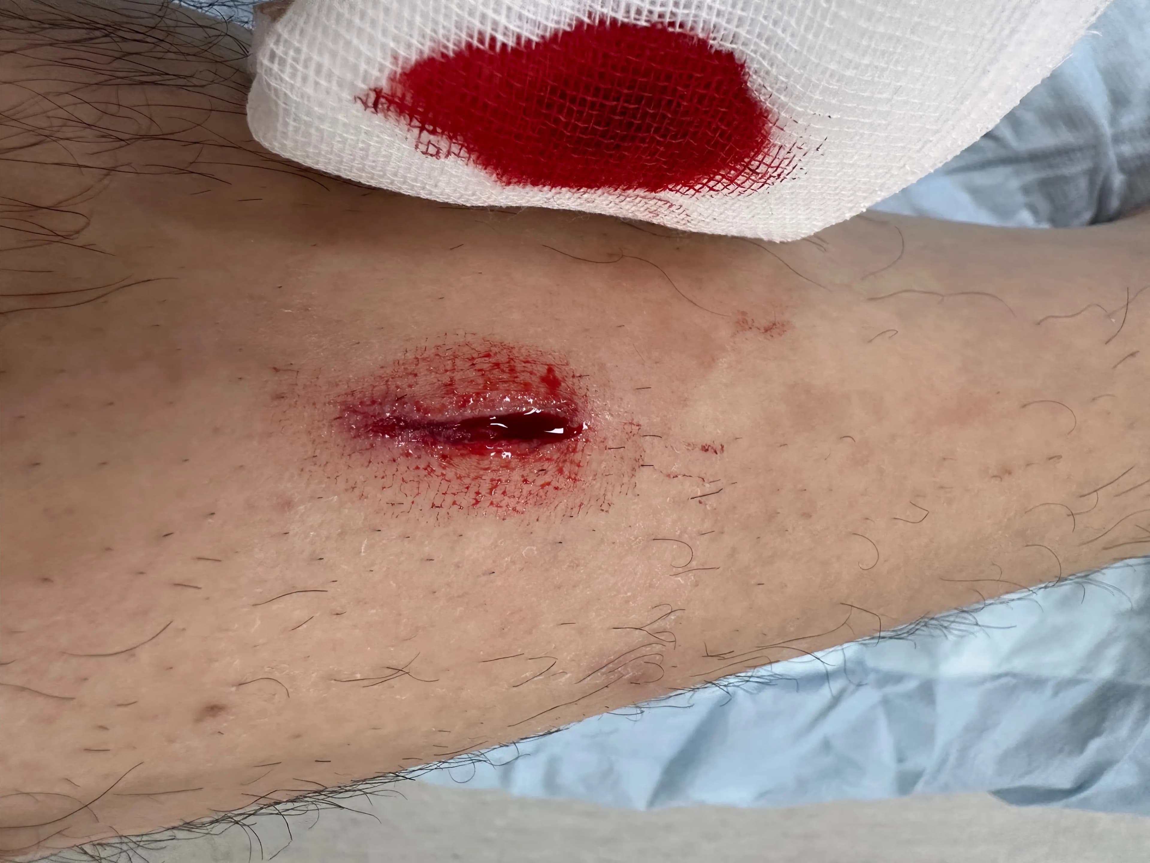 Sanggye Paik Hospital ER Review – Criteria for Stitches, Dressing Method, and Healing Time for Stitched Wounds-7