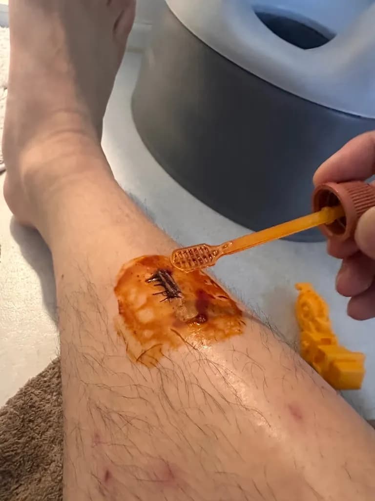 Sanggye Paik Hospital ER Review – Criteria for Stitches, Dressing Method, and Healing Time for Stitched Wounds-16