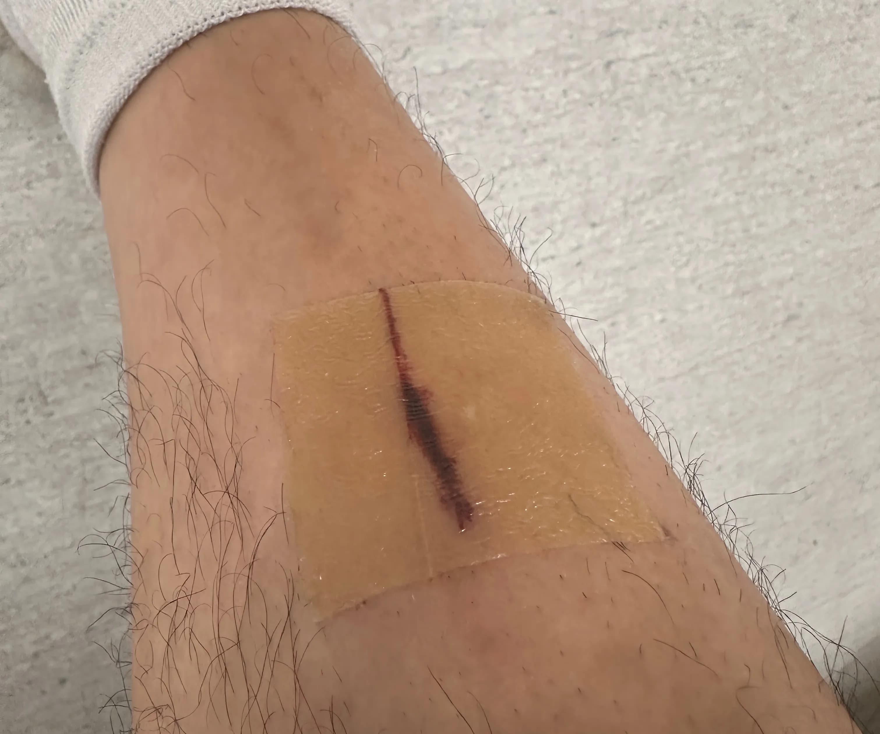 Sanggye Paik Hospital ER Review – Criteria for Stitches, Dressing Method, and Healing Time for Stitched Wounds-1