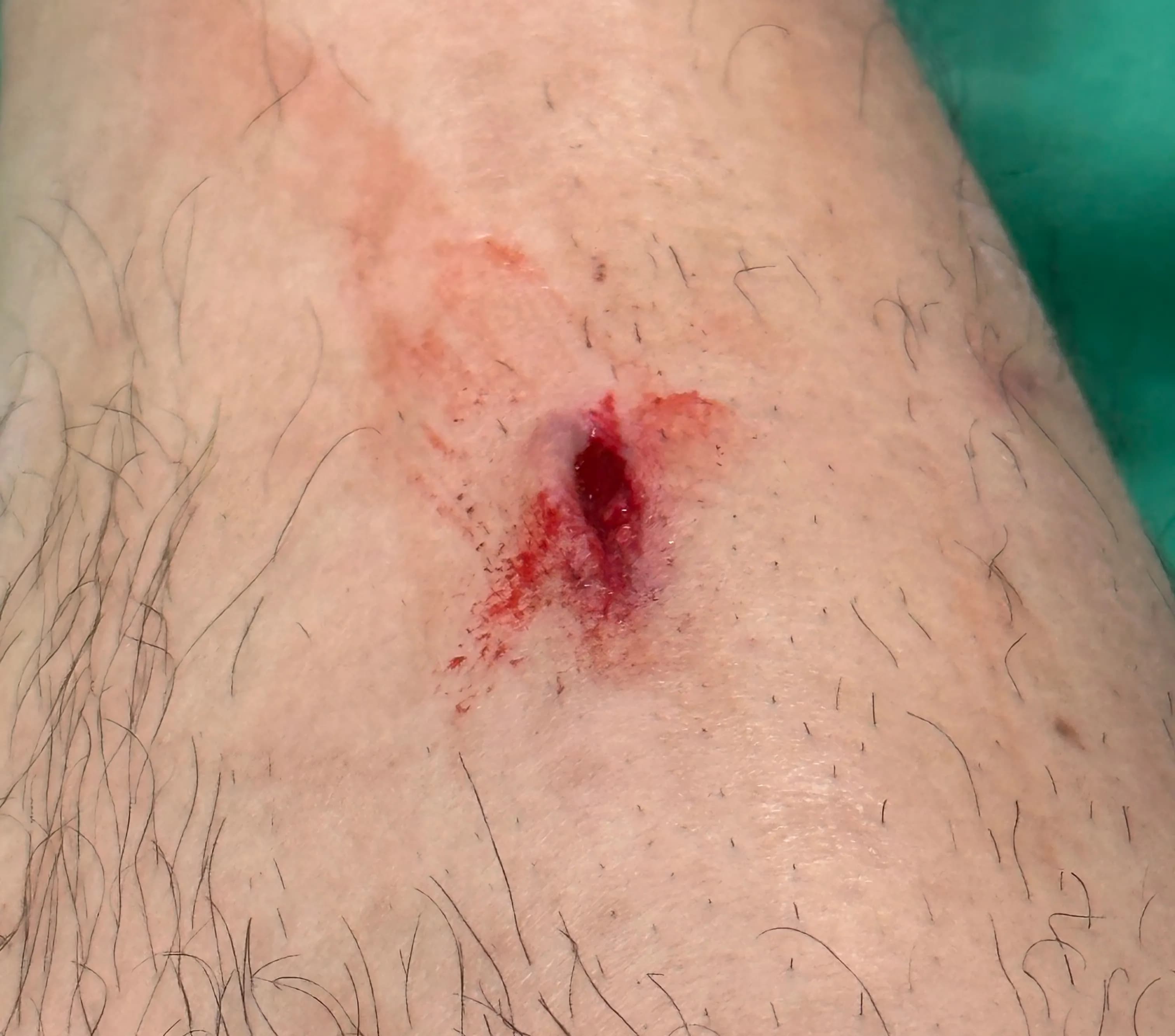 Sanggye Paik Hospital ER Review – Criteria for Stitches, Dressing Method, and Healing Time for Stitched Wounds-8