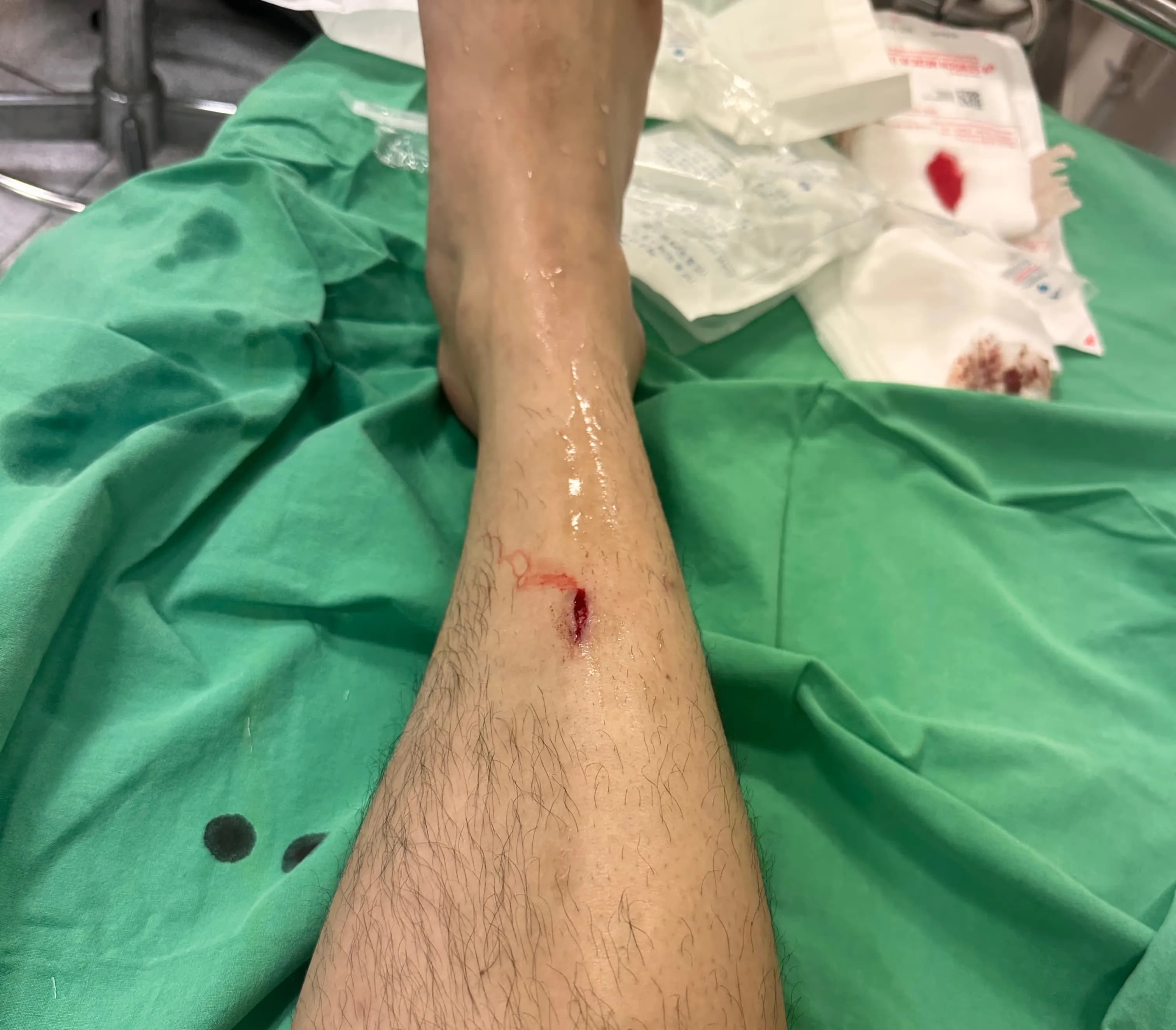 Sanggye Paik Hospital ER Review – Criteria for Stitches, Dressing Method, and Healing Time for Stitched Wounds-9