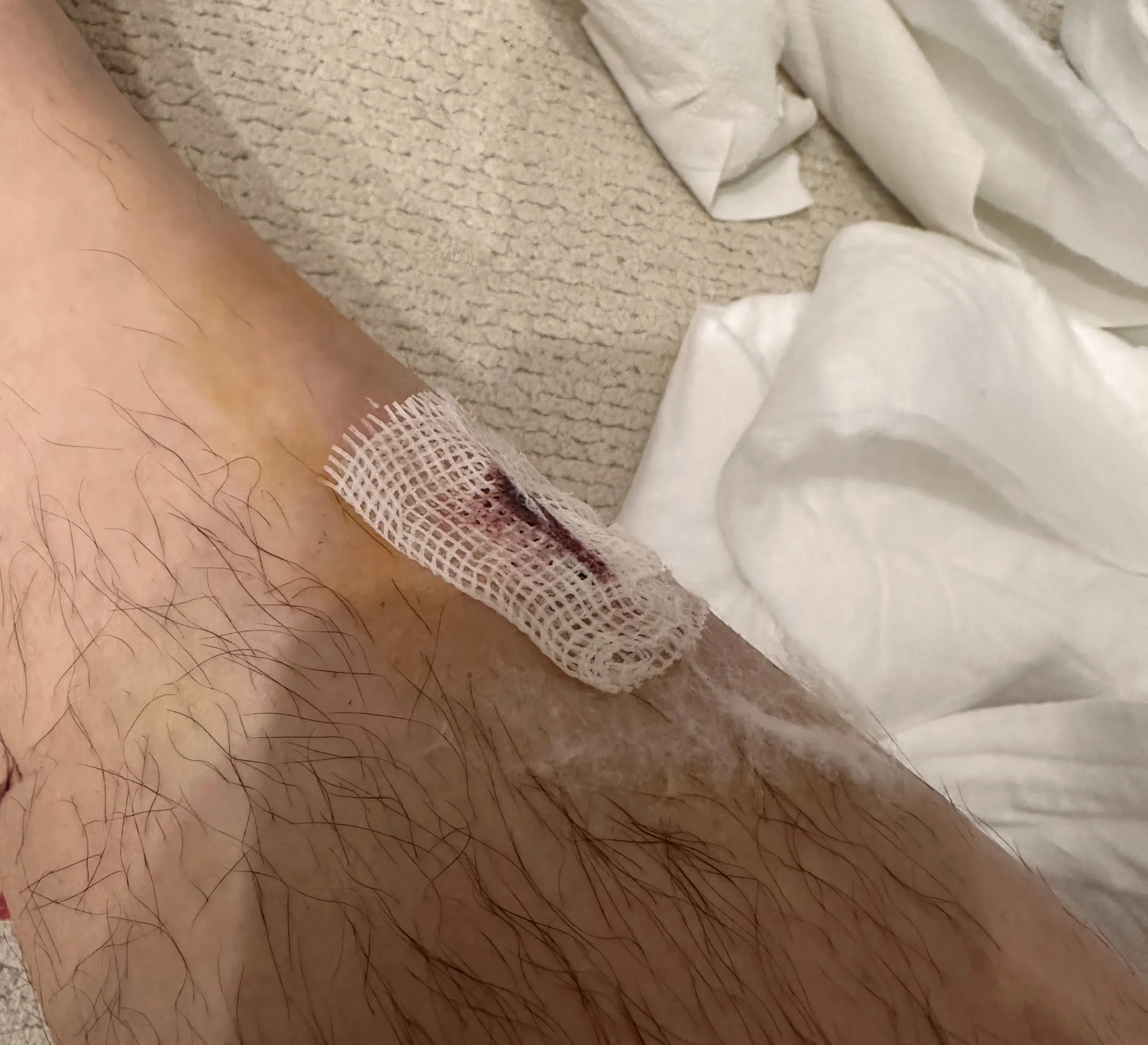 Sanggye Paik Hospital ER Review – Criteria for Stitches, Dressing Method, and Healing Time for Stitched Wounds-11