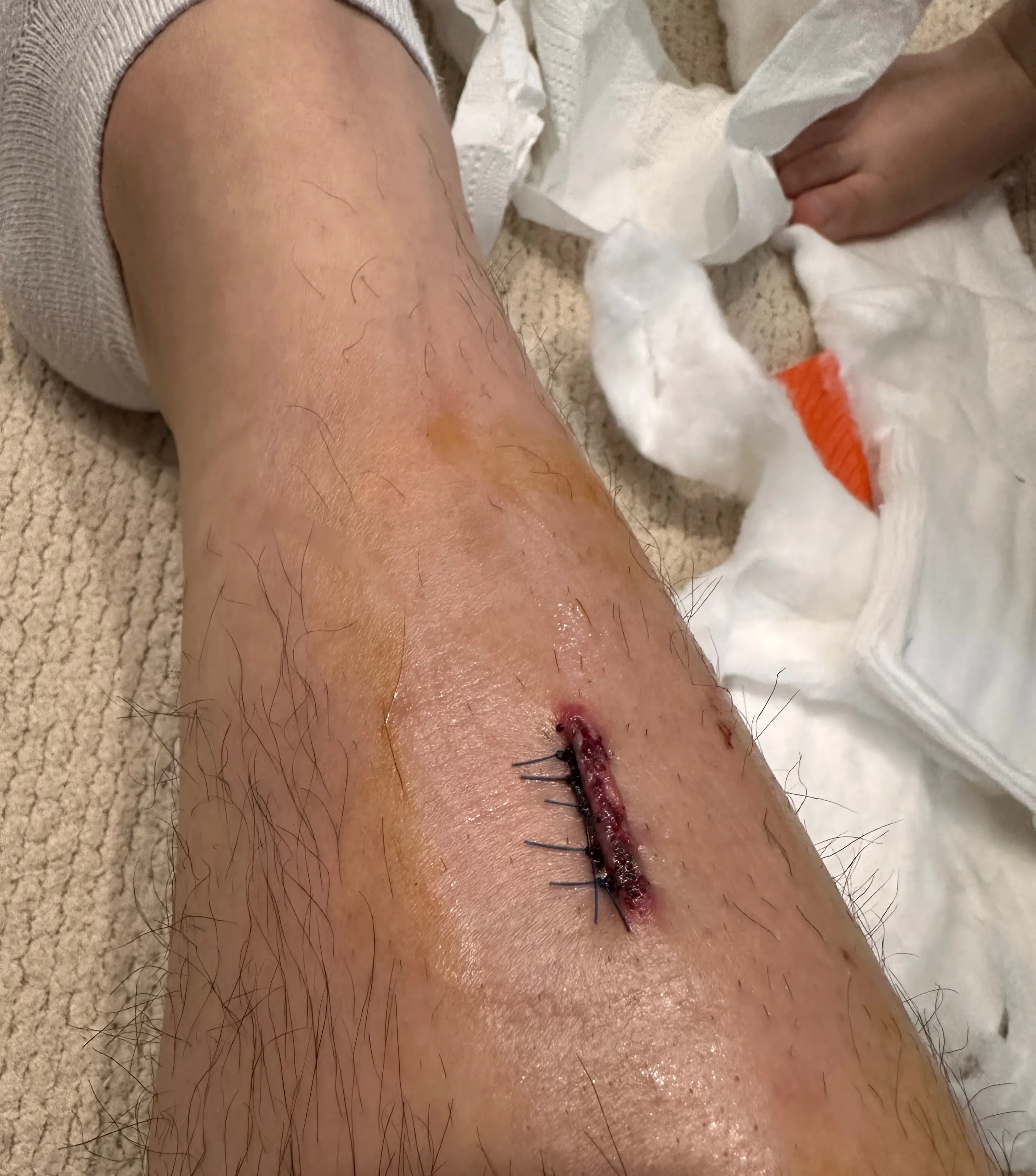 Sanggye Paik Hospital ER Review – Criteria for Stitches, Dressing Method, and Healing Time for Stitched Wounds-15