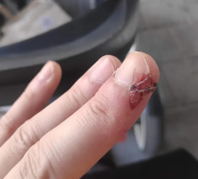 칼에 베인 상처 회복 기간-2