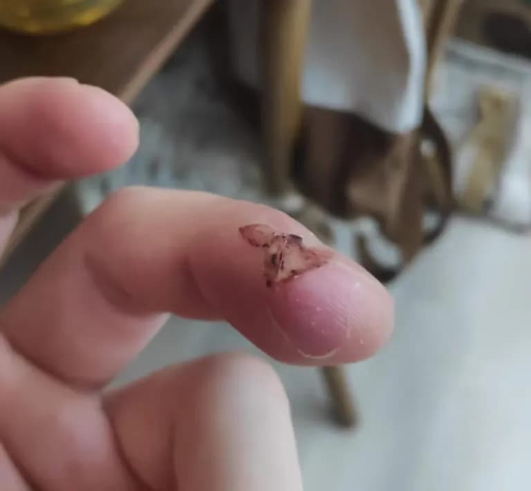 칼에 베인 상처 회복 기간-3