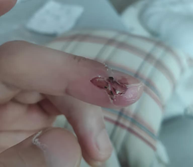 칼에 베인 상처 회복 기간-7