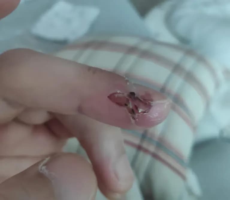 칼에 베인 상처 회복 기간-7