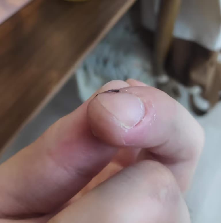 칼에 베인 상처 회복 기간-4