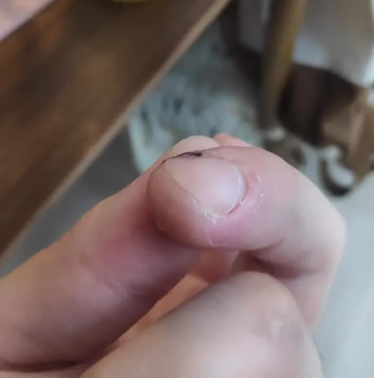 칼에 베인 상처 회복 기간-4