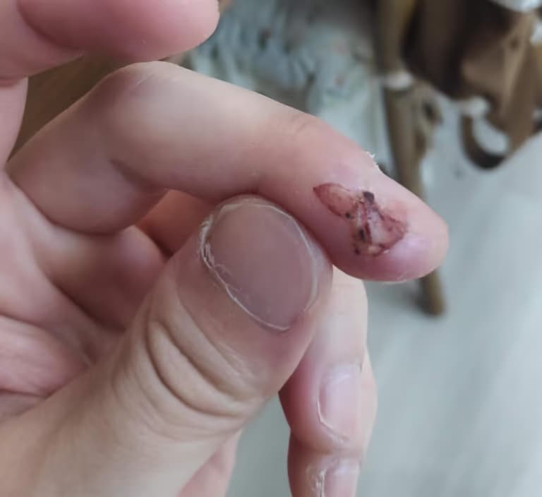 칼에 베인 상처 회복 기간-5