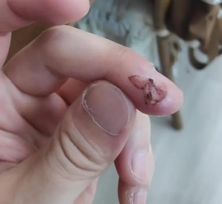 칼에 베인 상처 회복 기간-5