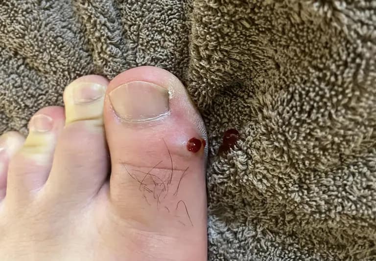 발가락에 난 물혹 - 결절종 짜보기-14