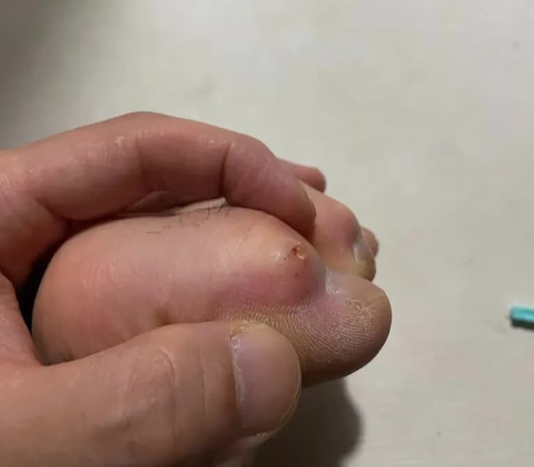 발가락에 난 물혹 - 결절종 짜보기-3