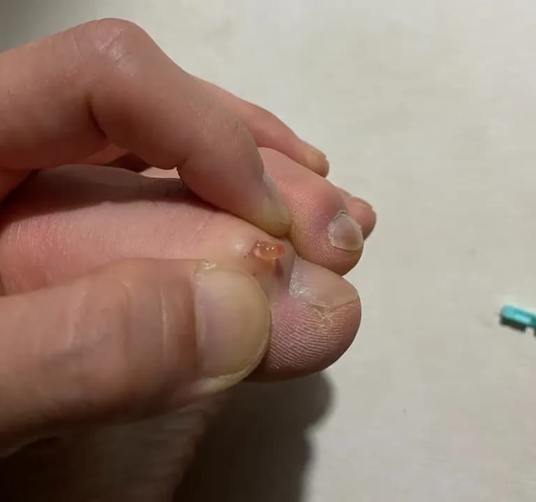 발가락에 난 물혹 - 결절종 짜보기-4