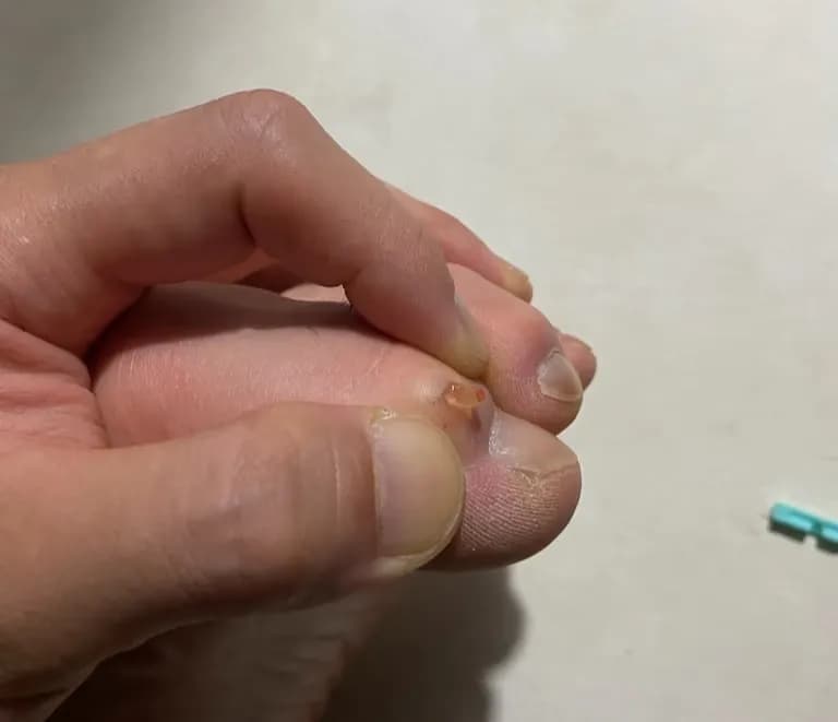 발가락에 난 물혹 - 결절종 짜보기-5