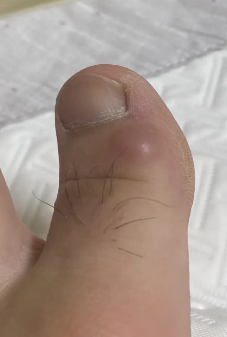 발가락에 난 물혹 - 결절종 짜보기-6