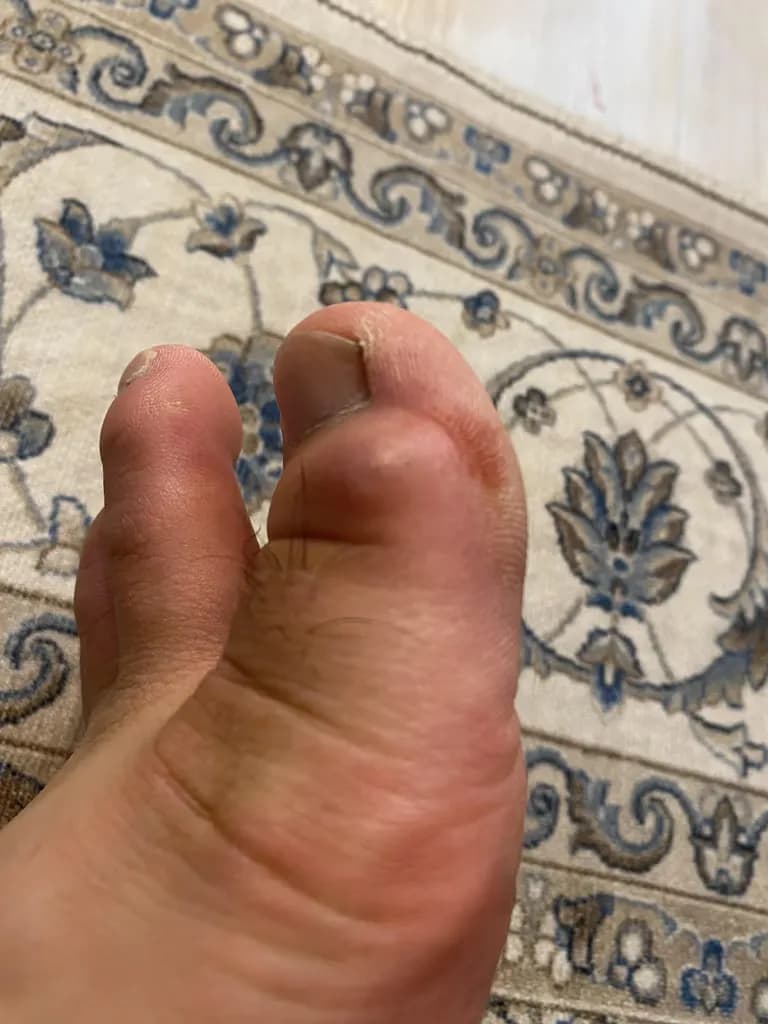 발가락에 난 물혹 - 결절종 짜보기-15