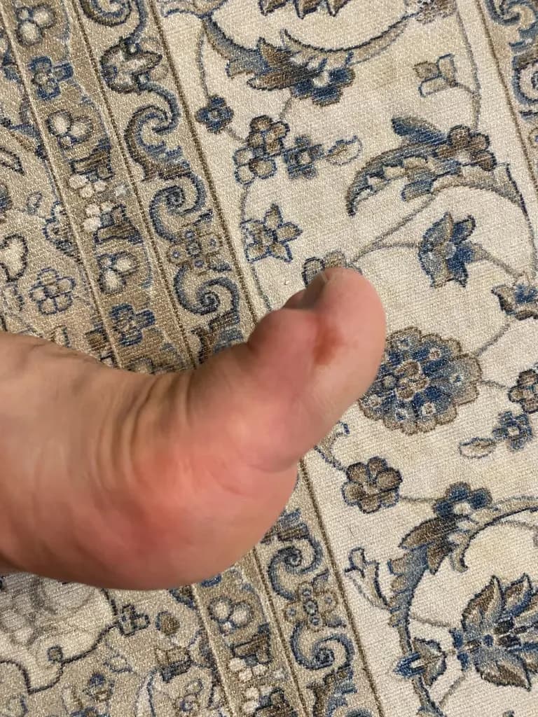 발가락에 난 물혹 - 결절종 짜보기-16