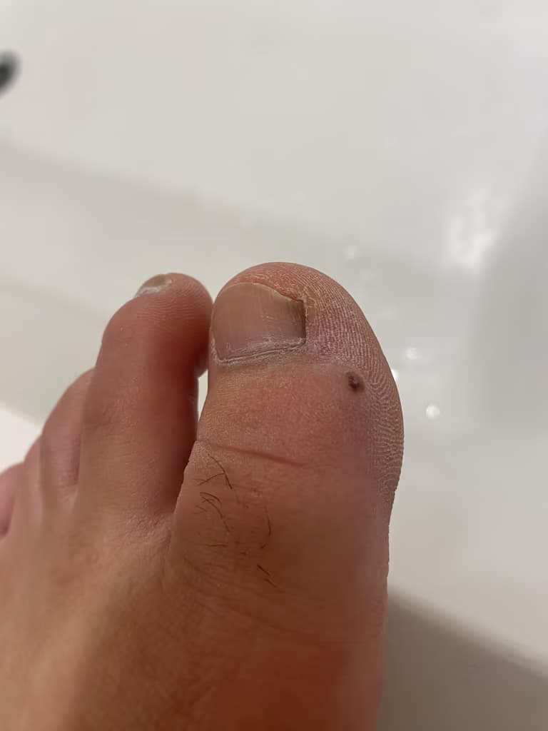 발가락 결절종 수술 후기, 수술 상처 관리 방법