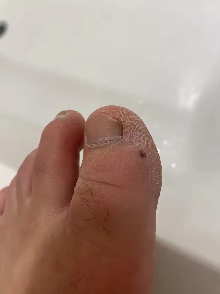 발가락 결절종 수술 후기, 수술 상처 관리 방법-2