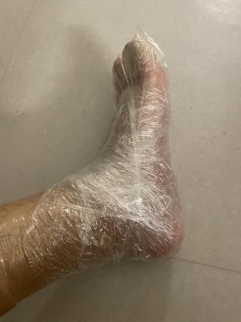 발가락 결절종 수술 후기, 수술 상처 관리 방법-9