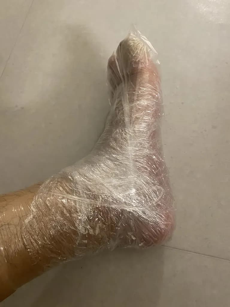 발가락 결절종 수술 후기, 수술 상처 관리 방법-9