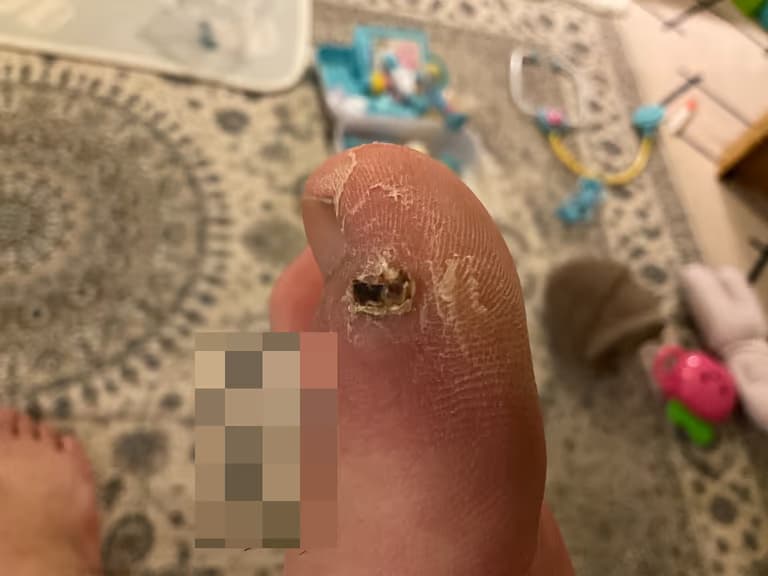 발가락 결절종 수술 후기, 수술 상처 관리 방법-18