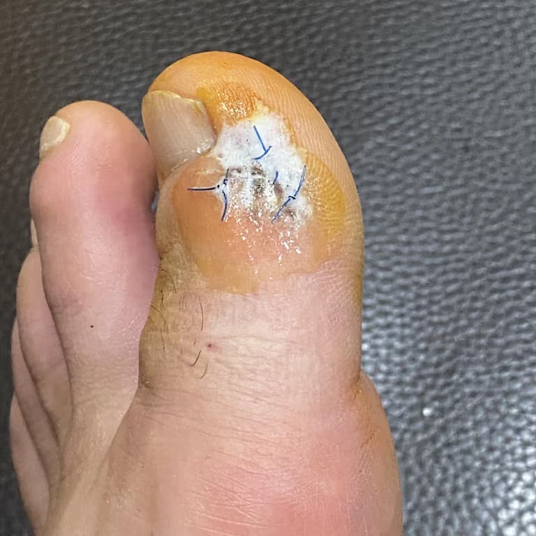 발가락 결절종 수술 후기, 수술 상처 관리 방법-4