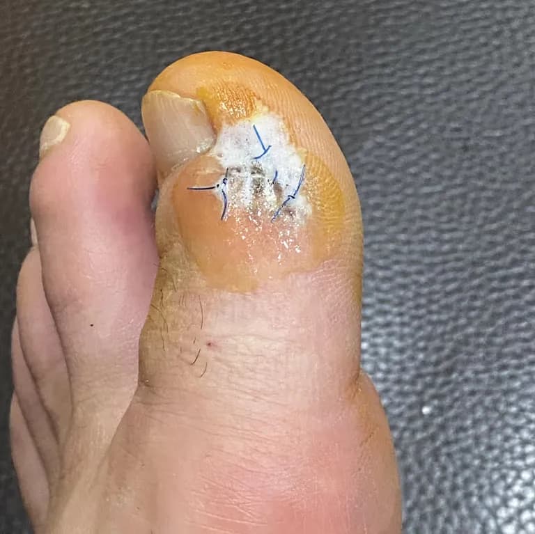 발가락 결절종 수술 후기, 수술 상처 관리 방법-4