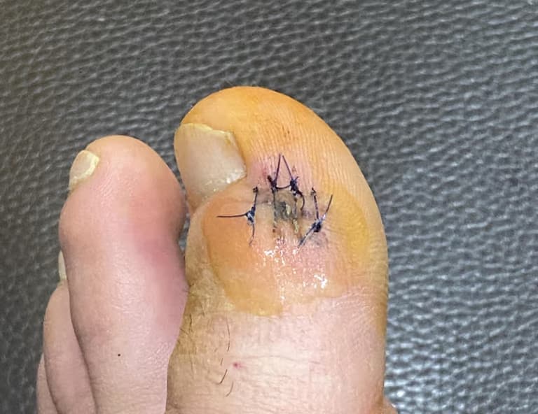 발가락 결절종 수술 후기, 수술 상처 관리 방법-5