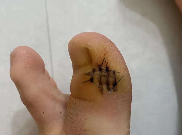 발가락 결절종 수술 후기, 수술 상처 관리 방법-6