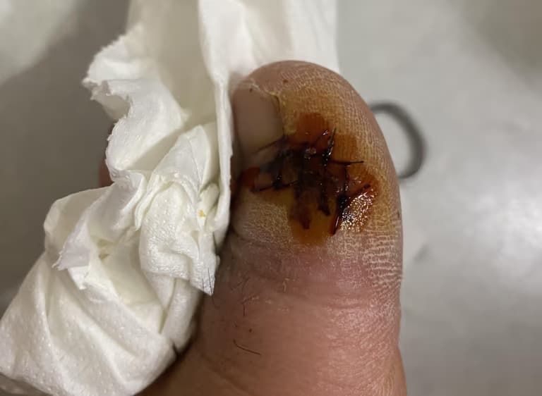 발가락 결절종 수술 후기, 수술 상처 관리 방법-7