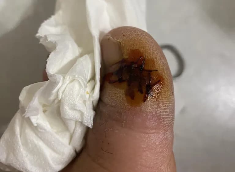 발가락 결절종 수술 후기, 수술 상처 관리 방법-7