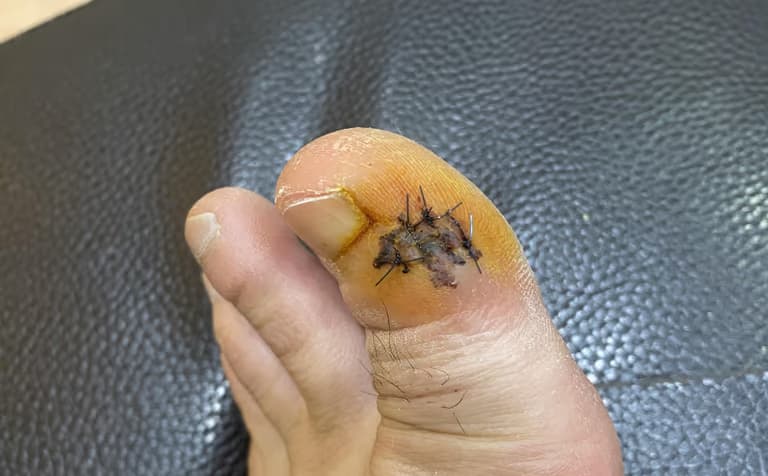 발가락 결절종 수술 후기, 수술 상처 관리 방법-10