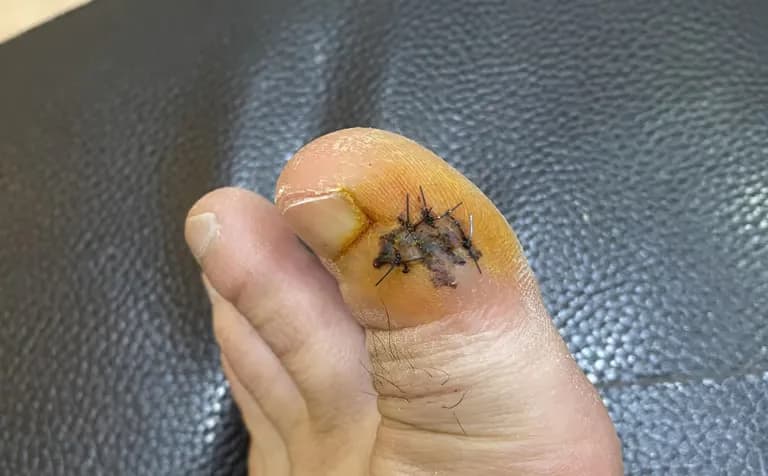 발가락 결절종 수술 후기, 수술 상처 관리 방법-10