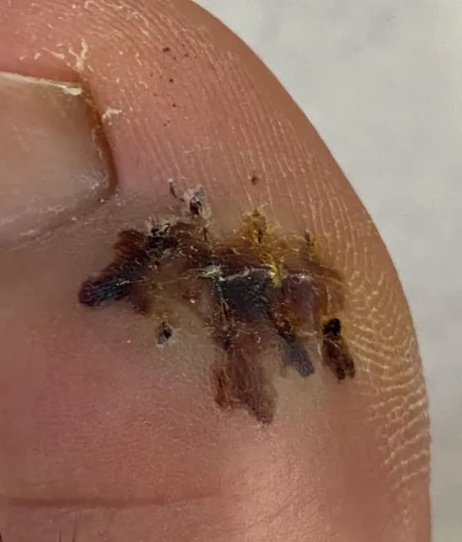 발가락 결절종 수술 후기, 수술 상처 관리 방법-11