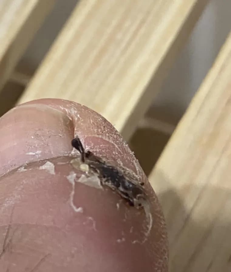 발가락 결절종 수술 후기, 수술 상처 관리 방법-12