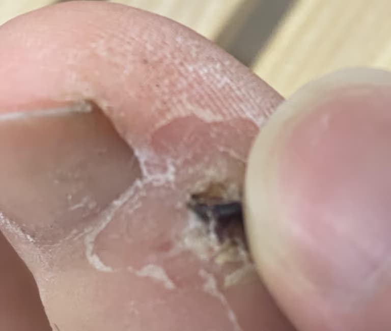 발가락 결절종 수술 후기, 수술 상처 관리 방법-14