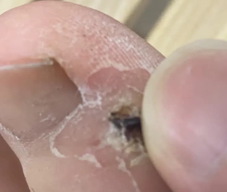 발가락 결절종 수술 후기, 수술 상처 관리 방법-13