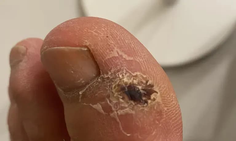 발가락 결절종 수술 후기, 수술 상처 관리 방법-14