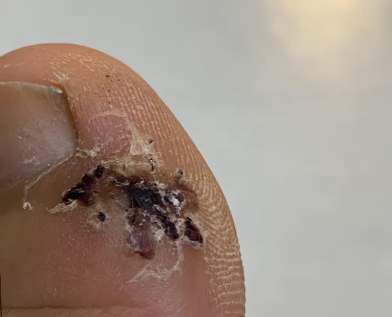 발가락 결절종 수술 후기, 수술 상처 관리 방법-16