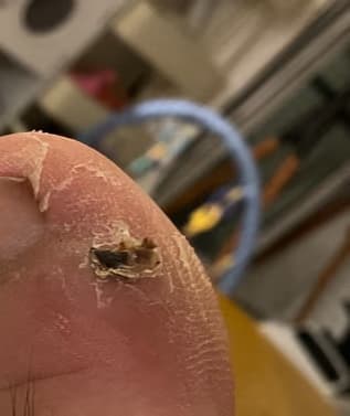 발가락 결절종 수술 후기, 수술 상처 관리 방법-17