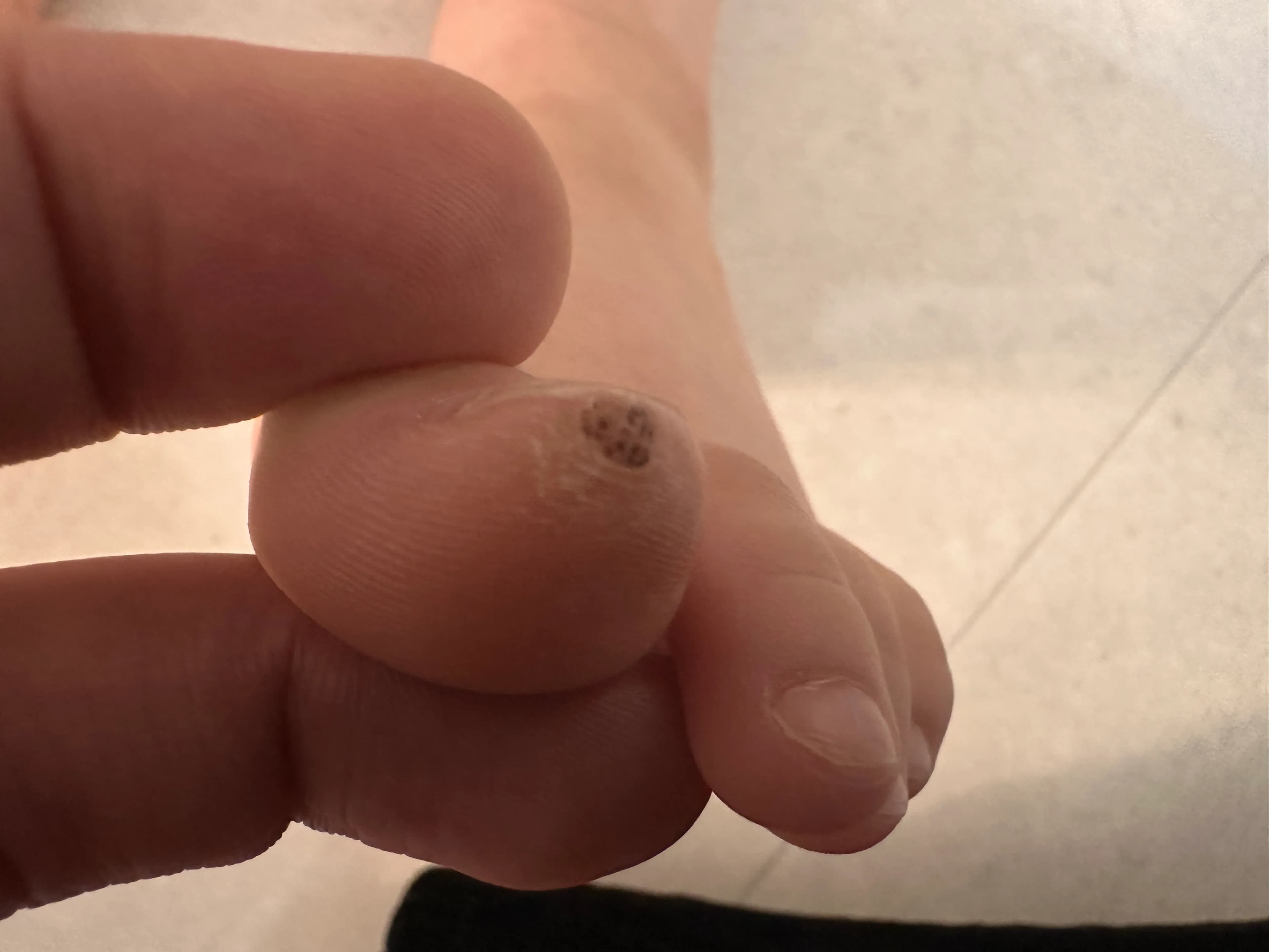 만4세 아기 발가락 사마귀 제거 후기-12