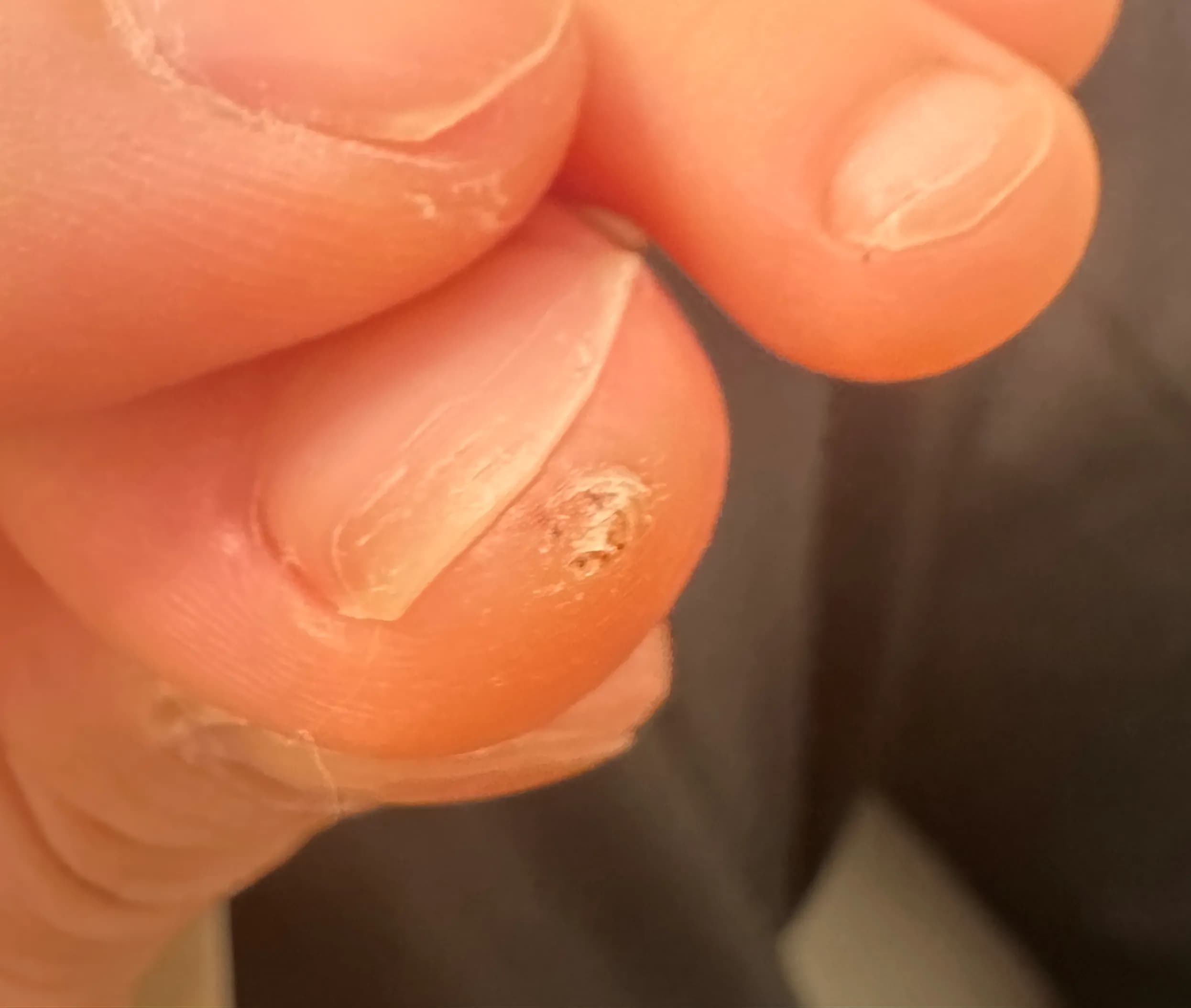 만4세 아기 발가락 사마귀 제거 후기-2